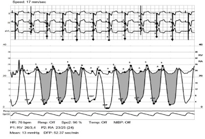 Balloon Valvuloplasty for Annular- and Leaflet-Level